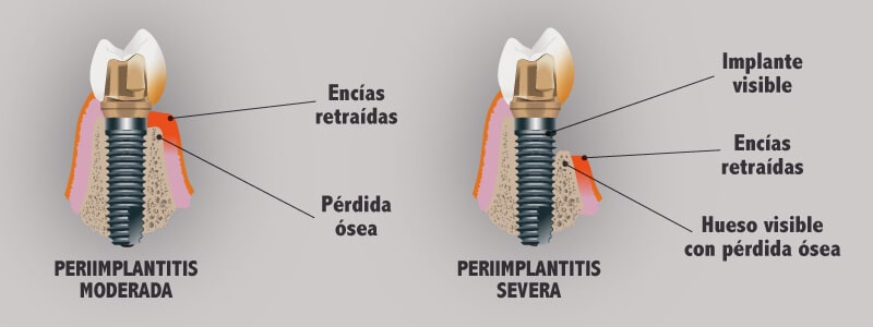 Cómo evitar la periimplantitis tras colocarme implantes dentales