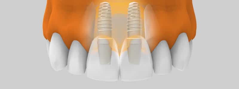 Implantología estética - Implantes en zona estética