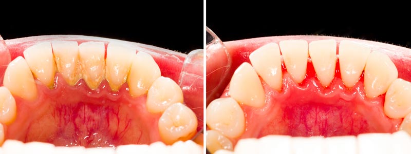 Placa bacteriana - Sarro dental