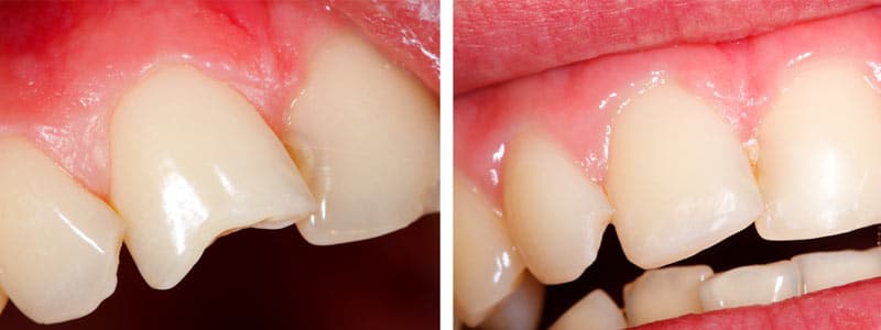 Carillas dentales - Carillas de composite