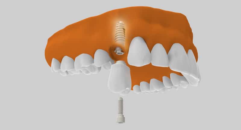 20 Preguntas sobre implantes dentales