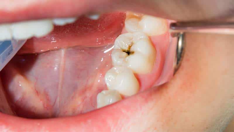 dental, ¿cuáles son sus causas sus