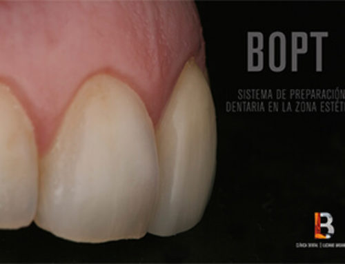 Introducimos la técnica BOPT como sistema de preparación dentaria de la zona estética.