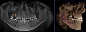 ¿Duelen los implantes dentales al morder?