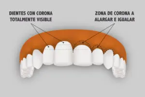 Alargamiento de corona dentaria