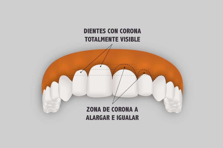 Cirugía Estética de la encía - Alargamiento de corona dentaria.