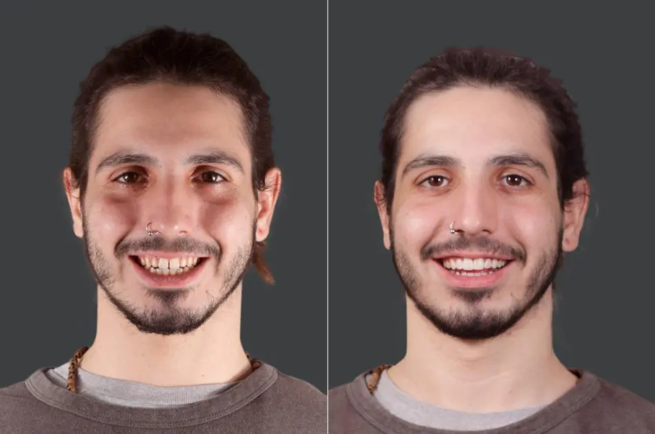 Diseño de sonrisa - Antes y después.