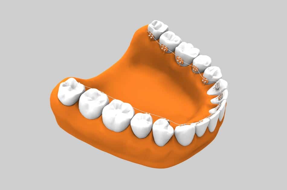 Ortodoncia estética - Ortodoncia lingual