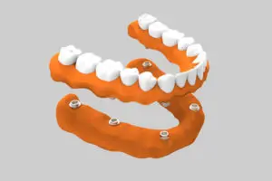 Prótesis dental - Prótesis dental sobre implante