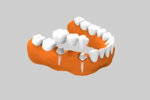 Prótesis dental - Prótesis fija sobre diente