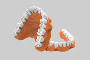 Prótesis dental - Prótesis removible