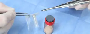 Implantología estética - Implante dental