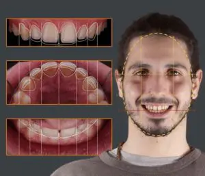 Carillas dentales - Diseño de sonrisa