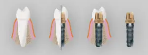 20 Preguntas sobre implantes dentales
