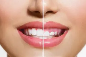 Cirugía oral - Cirugía estética de la encía