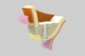 Cirugía oral - Injerto de hueso