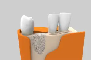 Cirugía oral - Regeneración ósea