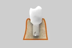 Características de los implantes dentales cortos