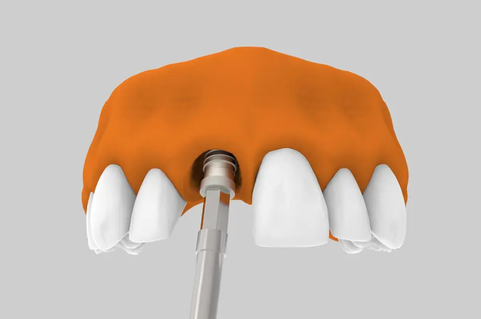 Implantes dentales en zona estética - Especialistas en implantes dentales.