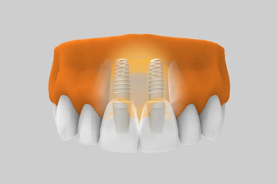 Implantes dentales en zona estética - Tratamiento.