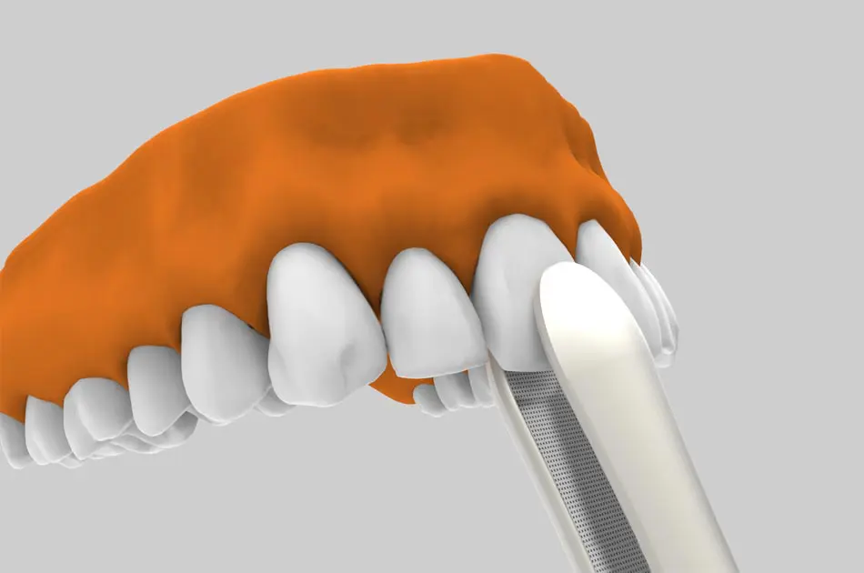 Implantes dentales post extracción con óptima integración.