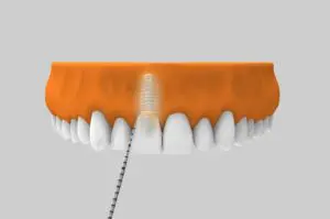 Mantenimiento de implantes dentales - Revisiones periódicas