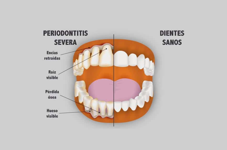 Periodoncia - Periodontitis severa