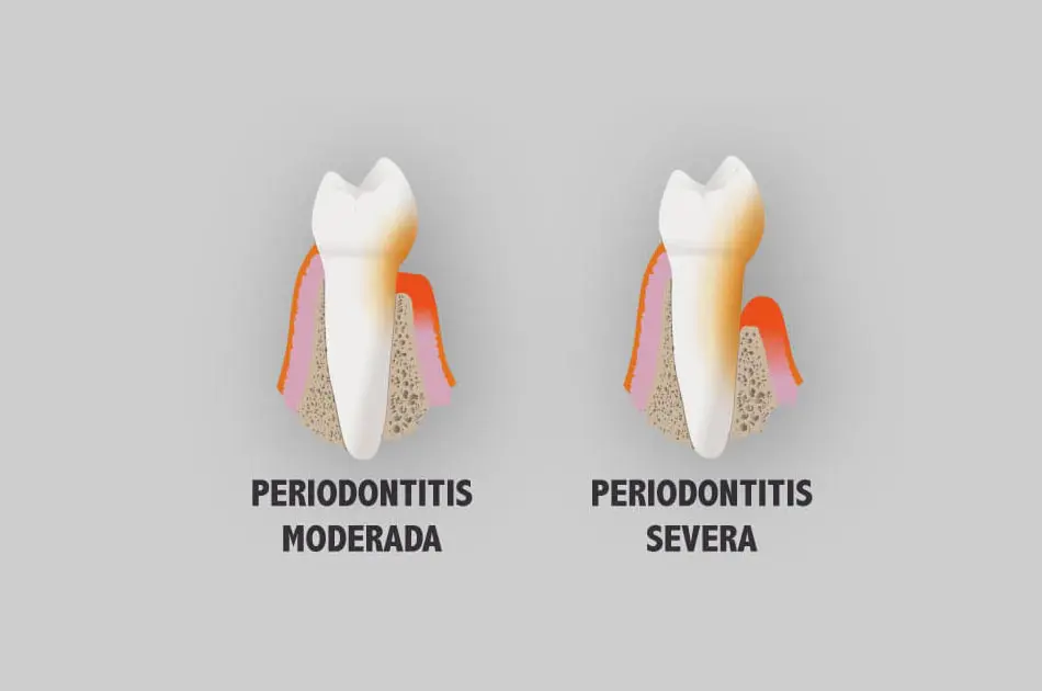 Periodoncia - Periodontitis