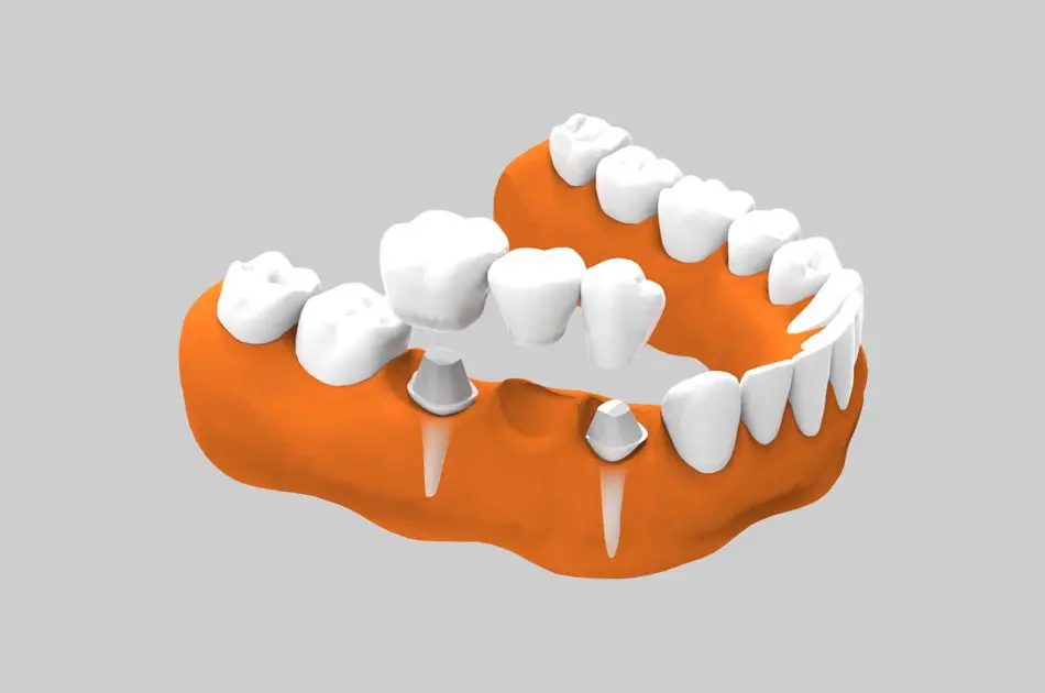 Prótesis dental sobre diente