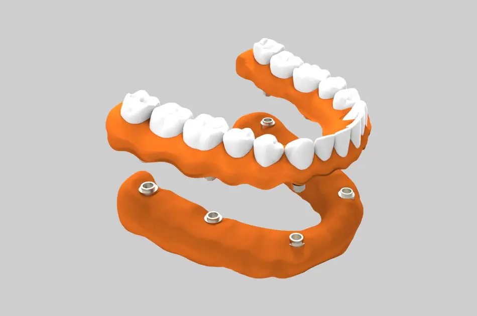 Prótesis dental sobre implante