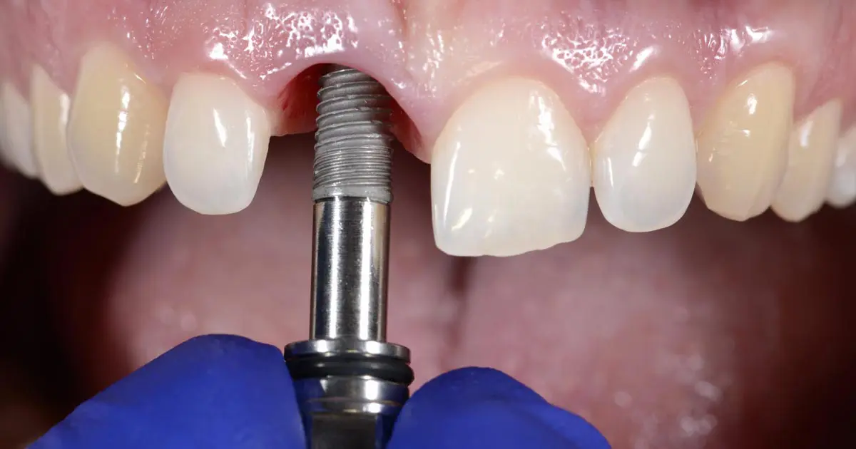 En qué consiste el tratamiento con implantes dentales