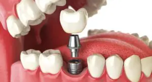 Tratamiento con implantes dentales - Partes de un implante dental