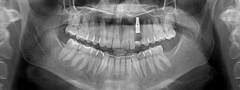 Cómo es la cirugía en un tratamiento con implantes dentales