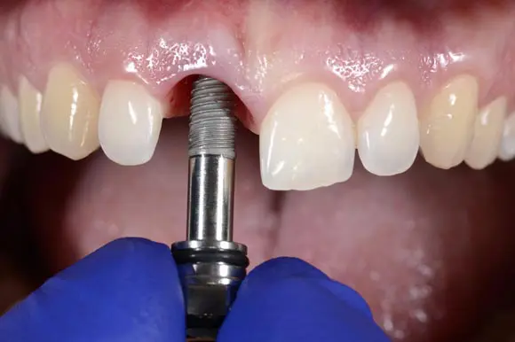 En qué consiste el tratamiento con implantes dentales