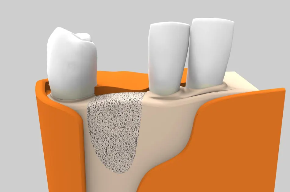 Cirugía oral - Regeneración ósea