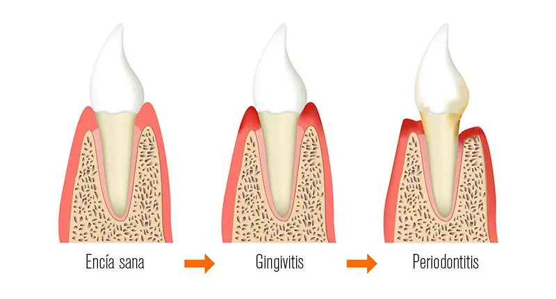 Qué es la gingivitis y por qué se produce
