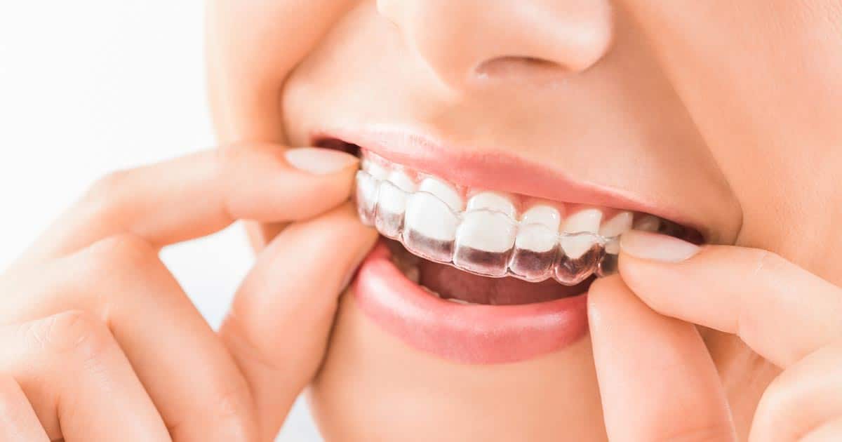 Invisalign: ¡descubre la ortodoncia invisible!