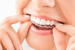 Invisalign: ¡descubre la ortodoncia invisible!