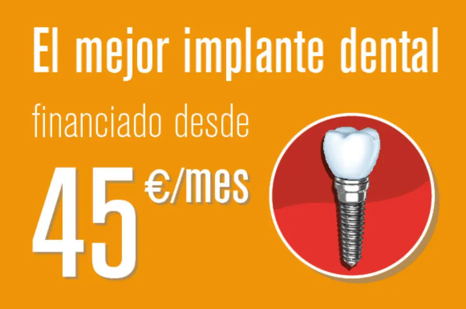 Financiación de Implantes Dentales en Madrid