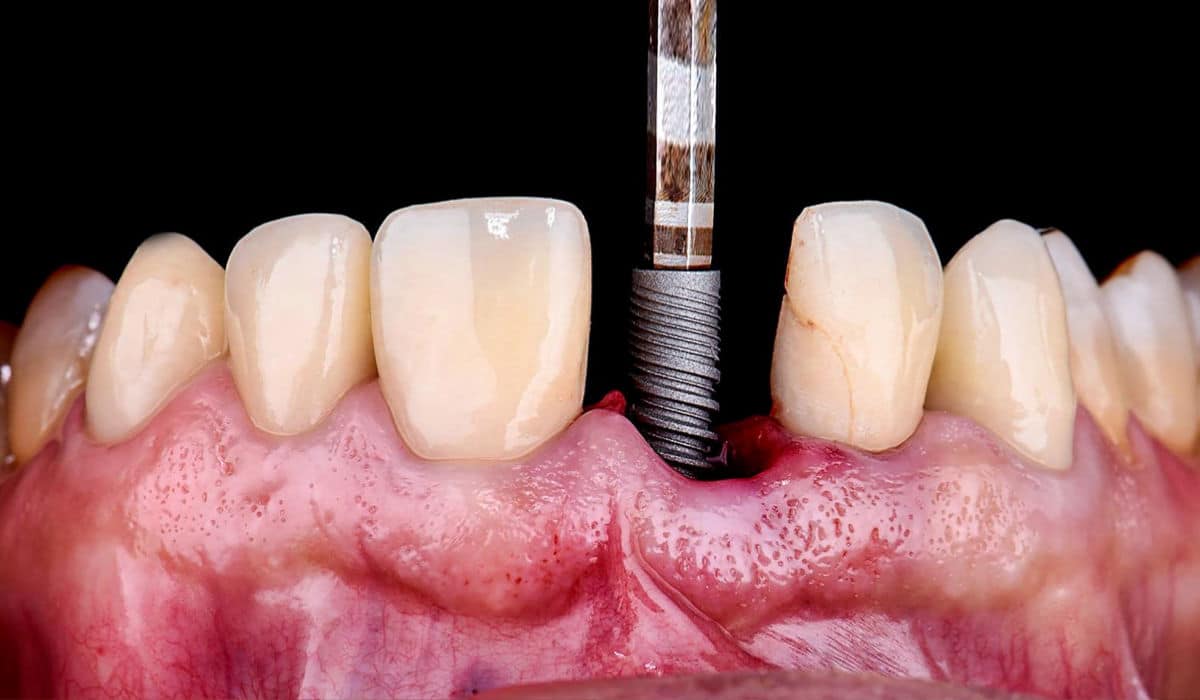 ¿Qué es la implantología dental?
