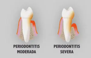 Periodontitis moderada y severa