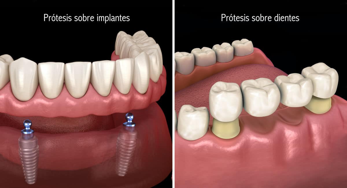 Prótesis dentales sobre implantes y sobre dientes