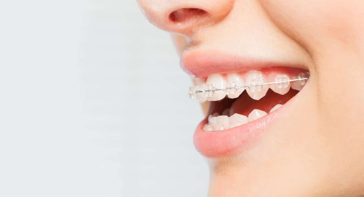 Tipos de ortodoncia fija