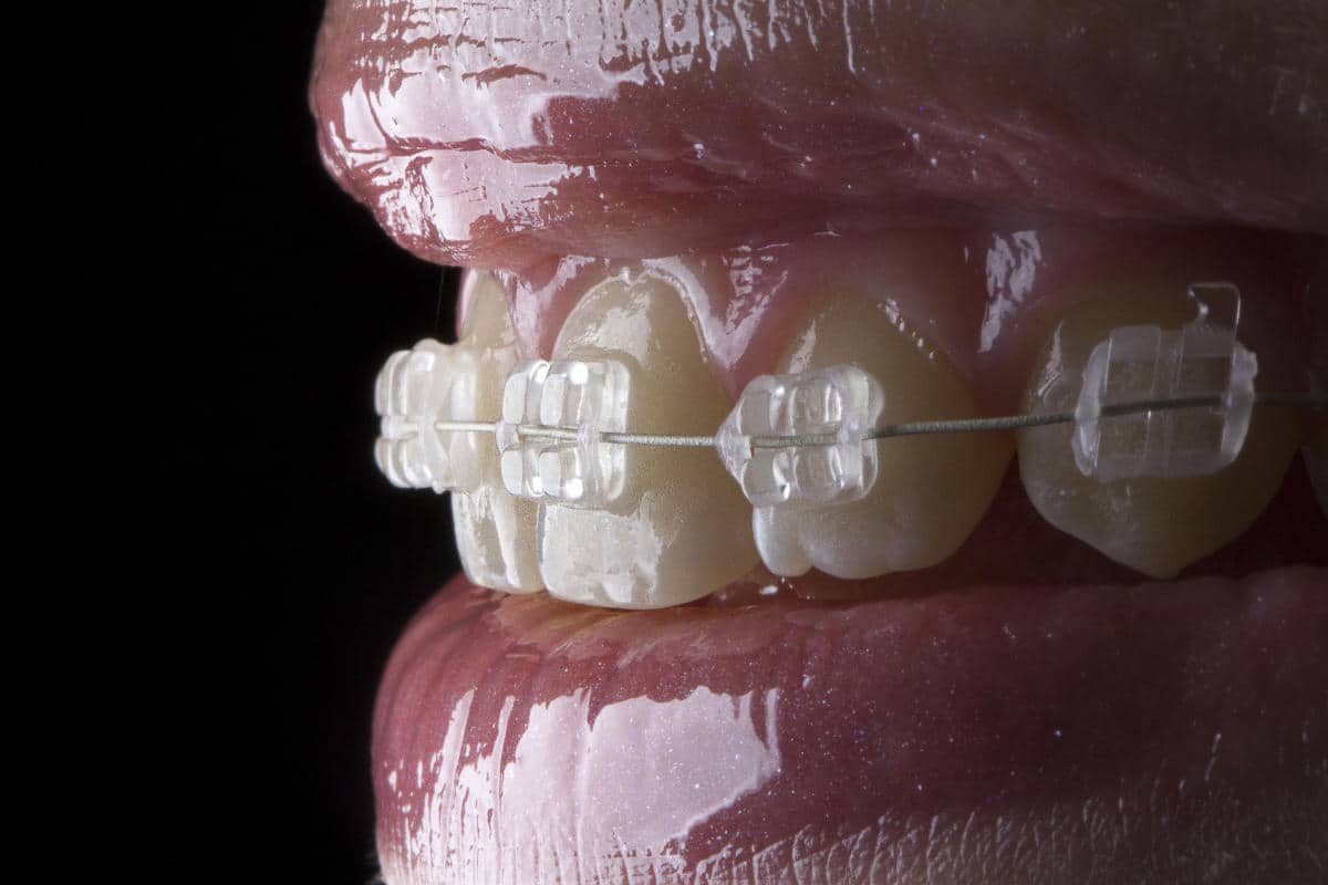 Tipos de ortodoncia. Descubre cuál es la mejor para ti.