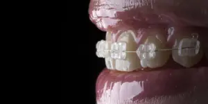 Tipos de ortodoncia. Descubre cuál es la mejor para ti.