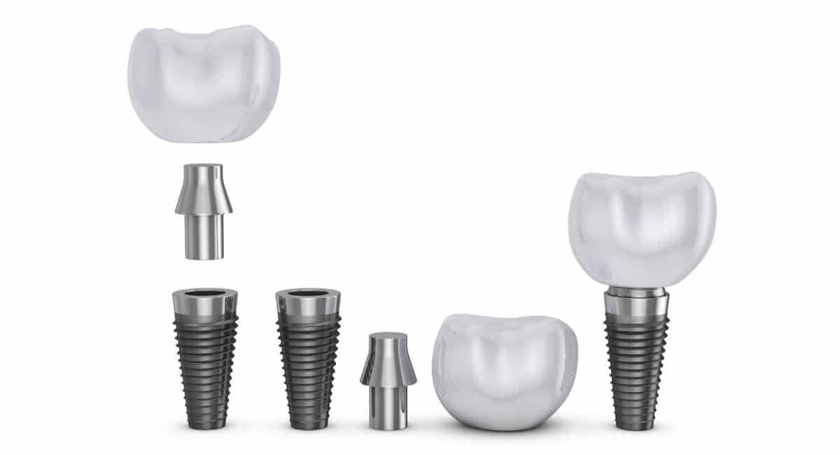 Partes de un implante dental