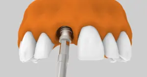 ¿Cuánto dura el proceso de colocación de un implante dental?