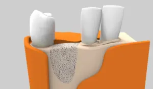 Pérdida ósea: factor fundamental que influye en el proceso de colocación de un implante dental
