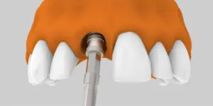 ¿Cuánto dura el proceso de colocación de un implante dental?