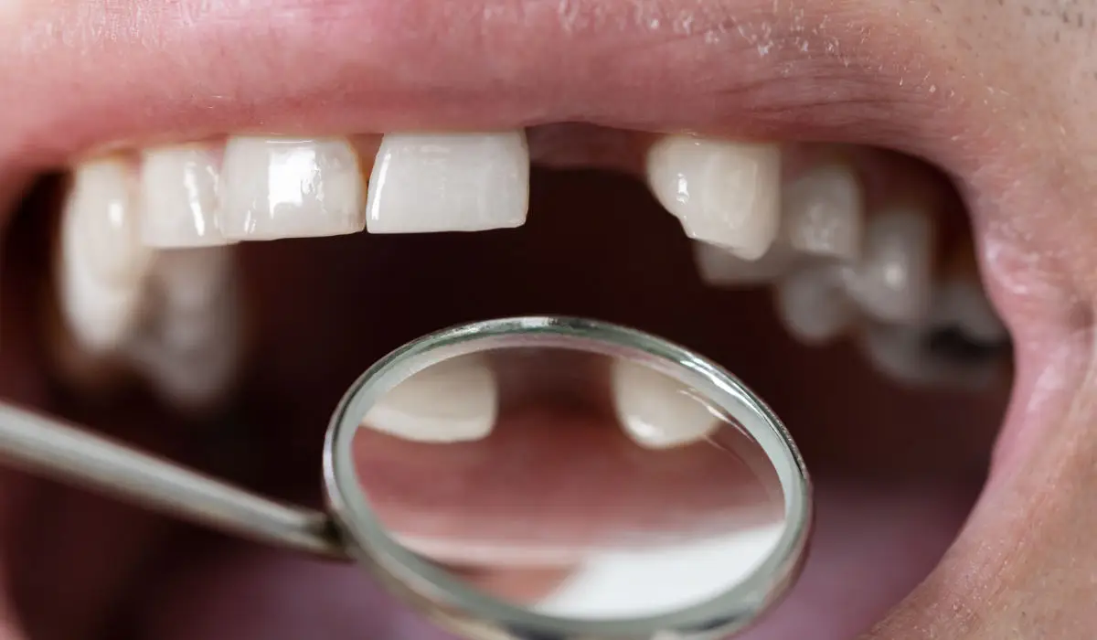 Pérdida de un diente - Urgencia dental